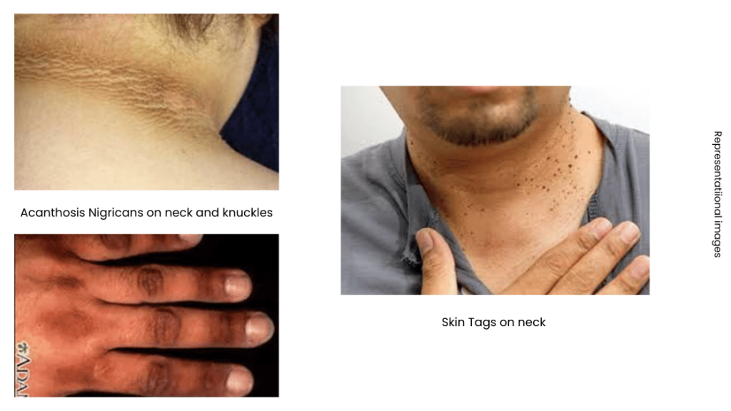 Acanthosis Nigricans on neck and knuckles. Skin Tags on neck